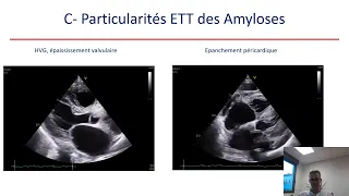 Bilan de cardiopathie hypertrophique