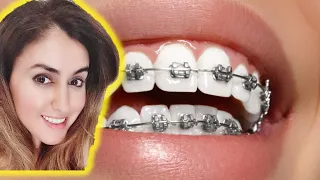 Hacks For Whiter Teeth With Braces!