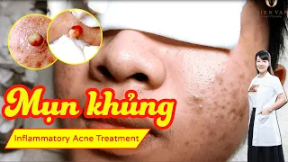 Điều trị mụn hiệu quả tại TPHCM |Hiền Vân Spa | Mụn bọc, mụn nang khổng lồ | Acne Treatment |611