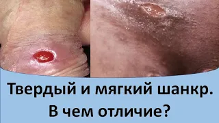 Твердый и мягкий шанкр.  В чем отличие?