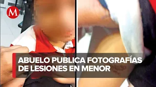 Abuelo de niño de kínder muestra fotos de presuntas lesiones