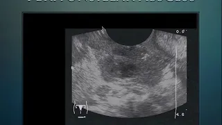 Ultrasound session for Fever Evaluation/ must see/very imp/multi system