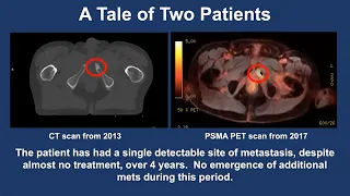 Oligometastatic Disease - 2021 Prostate Cancer Patient Conference