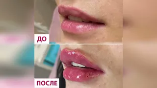 Результаты контурной пластики губ