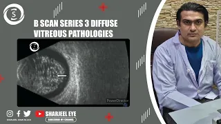 B scan series 3 diffuse vitreous pathologies