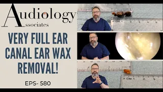 VERY FULL EAR CANAL EAR WAX REMOVAL - EP580