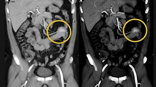 CTA of Small Bowel Obstruction: Some New Thoughts and Concepts Part 1