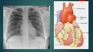 CXR ( Chest X ray in Cardiac disease )