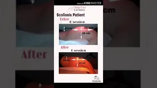 🌸 Scoliosis Patient 🌸