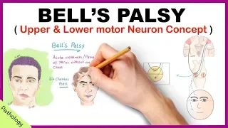 Bell's palsy Upper and Lower Motor Neuron Lesions - Simplified