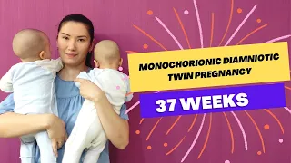 Monochorionic diamniotic twin pregnancy. Worries and advice. Delivery, childbirth in Kazakhstan.