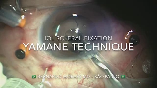 IOL scleral fixation (modified Yamane technique) - Author: Bernardo Moraes MD