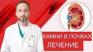 Мочекаменная болезнь. Способы удаления камней почек.