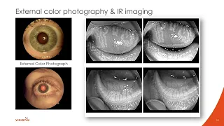 Optovue Solix by Visionix: Multimodality and Unparalleled Detail with Dr. Mile Brujic