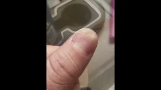 Lost Thumbnail Grows Back Time Lapse over 3 Months - Fingernail Grows Back