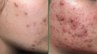 Treatment Of Inflammatory Acne, Acne On The Face