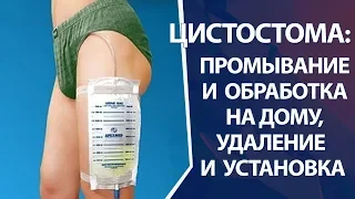 Цистостома: замена и промывание цистостомы на дому и в клинике, установка и удаление цистостомы