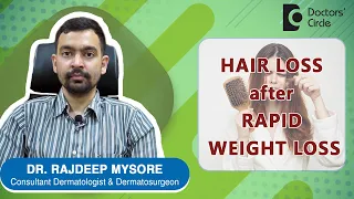 Oops !!! HAIR LOSS AFTER RAPID WEIGHT LOSS. Causes & Treatment -Dr. Rajdeep Mysore | Doctors' Circle