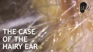 Ear Wax Removal of Matted Hairy Ear Wax off Ear Canal & Eardrum - #377