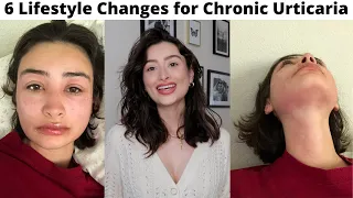 6 Lifestyle Changes I've Made Since Developing Chronic Urticaria | How I Manage Chronic Urticaria