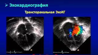 ДМПП или дефект межпредсердной перегородки: причины, симптомы, диагностика и лечение ДМПП