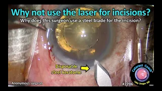 CataractCoach™ 2206: why not use the femto laser for incisions?