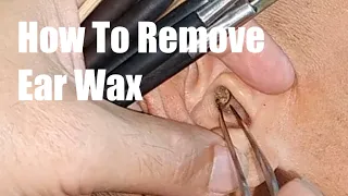 Ear cleaning real person | Removing ear wax in this way is so refreshing, have you tried it?