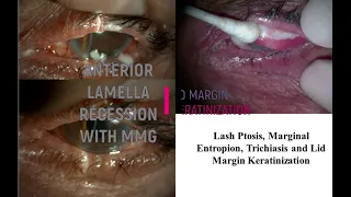 Anterior Lamellae Recession & Mucus membrane Graft in Severe Lid Margin Keratinization