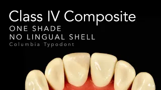 Class IV Composite Restoration | Step by Step One Shade Class IV Restorations