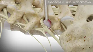 Endoscopic Lumbar Discectomy | Spine Institute of North America