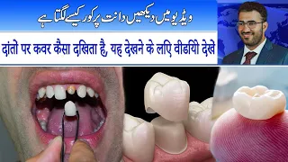 dant ka cover | daant ka cover | tooth cover | tooth cover | dant ki cap | daant ki cap