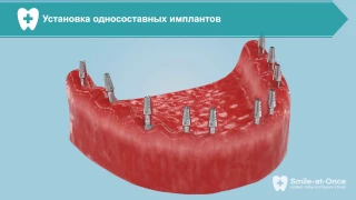 Базальная имплантация при отсутствии всех зубов