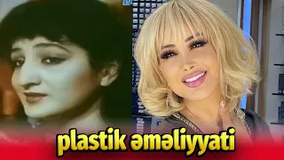 Azərbaycan müğənniləri plastik əməliyyatdan əvvəl - sonra