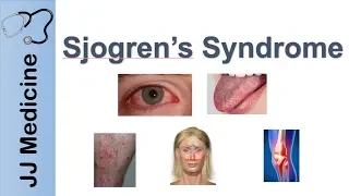 Sjogren’s Syndrome ("Dry Eye Syndrome") | Primary vs. Secondary, Symptoms, Diagnosis and Treatment