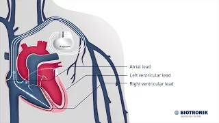 Cardiac Resynchronization Therapy – How it works