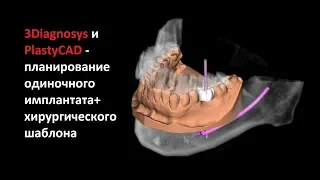 3Diagnosys и PlastyCAD - планирование одиночного имплантата+ хирургического шаблона