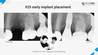 Dr. Yongseok CHO, Sewoung KIM, #25 Early implant surgery and prosthesis