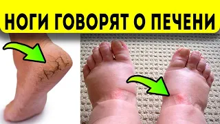 Как По Ногам Понять, Что Ваша Печень Нездорова?