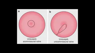 Valvula aórtica unicúspide; unicuspid aortic valve