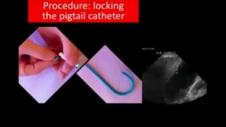 Ultrasound Guided Drainage of the Gallbladder