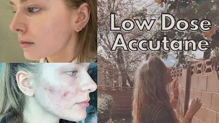 6 months post accutane results // LOW DOSE TREATMENT