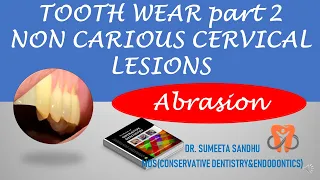 Non carious cervical lesions| Tooth Abrasion Causes and treatment| Nccl of teeth