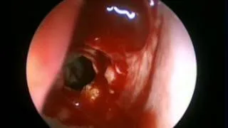 Office Sphenoidotomy Mycetoma - Office-Based Rhinology