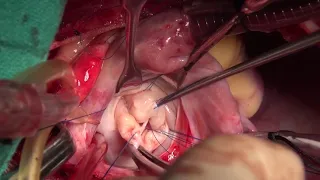 Surgery for Congenital Mitral Valve Disease (Type-III) by Dr. V. Devagourou