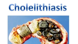 Cholelithiasis