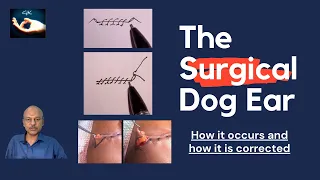 The Surgical Dog Ear: Why it occurs and how it is corrected!