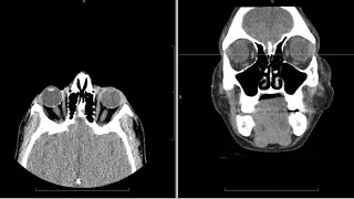 CT (computed tomography) face radiology search pattern