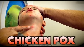 CHICKEN POX + RASH from WART VIRUS (Molluscum Contagiosum): Live Diagnosis | Dr. Paul