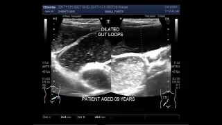 Ultrasound Video showing intestinal obstruction with dilated gut loops.