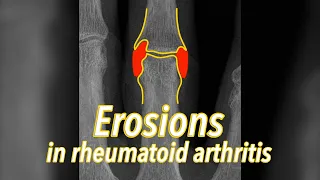 Erosions on X-rays in rheumatoid arthritis - explained in 30 seconds!